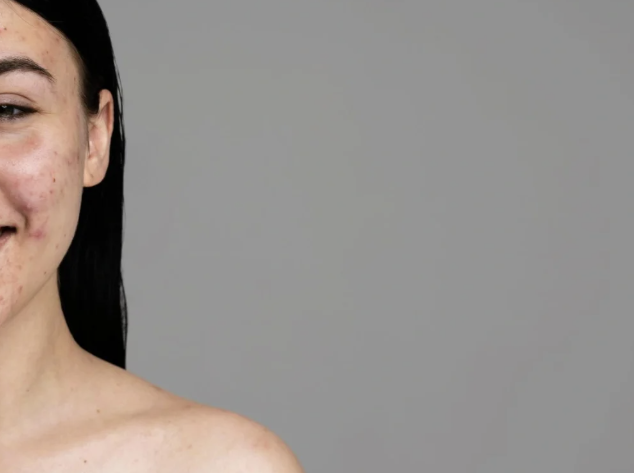 Cara Memilih Laser Flek Hitam Untuk Mengurangi Noda Gelap Secara Efektif